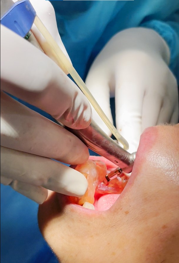 Best Dental Implant in Faridabad